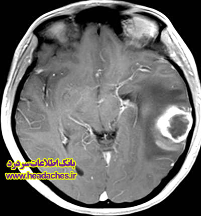 تصویری از یک تومور مغزی